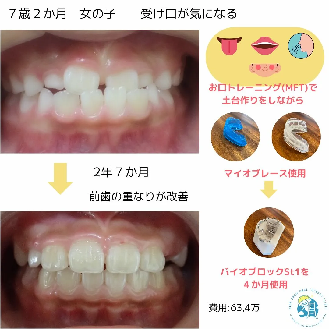 歯並びどう変わった？　受け口