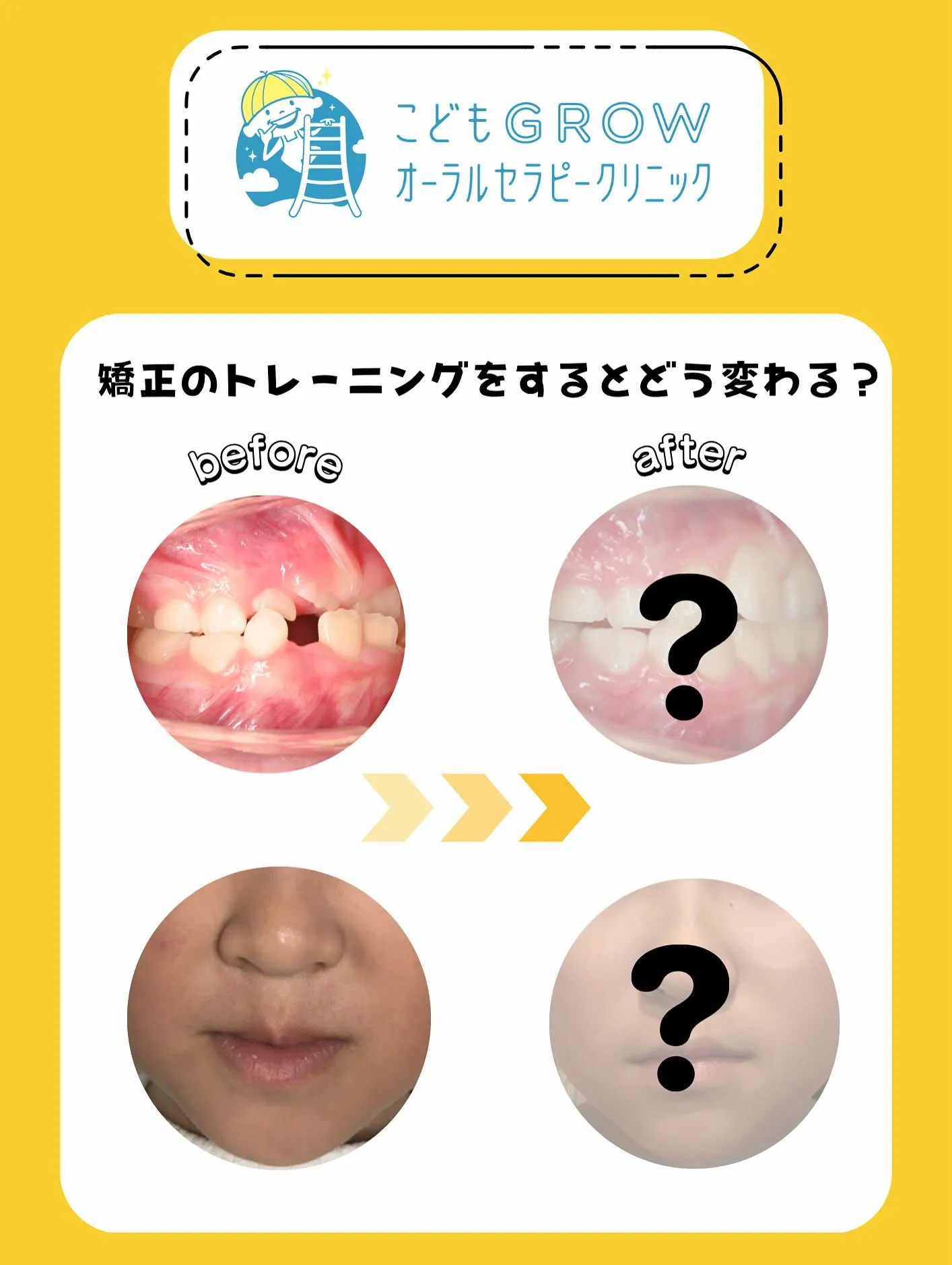 8歳女の子の経過途中の矯正症例です👧