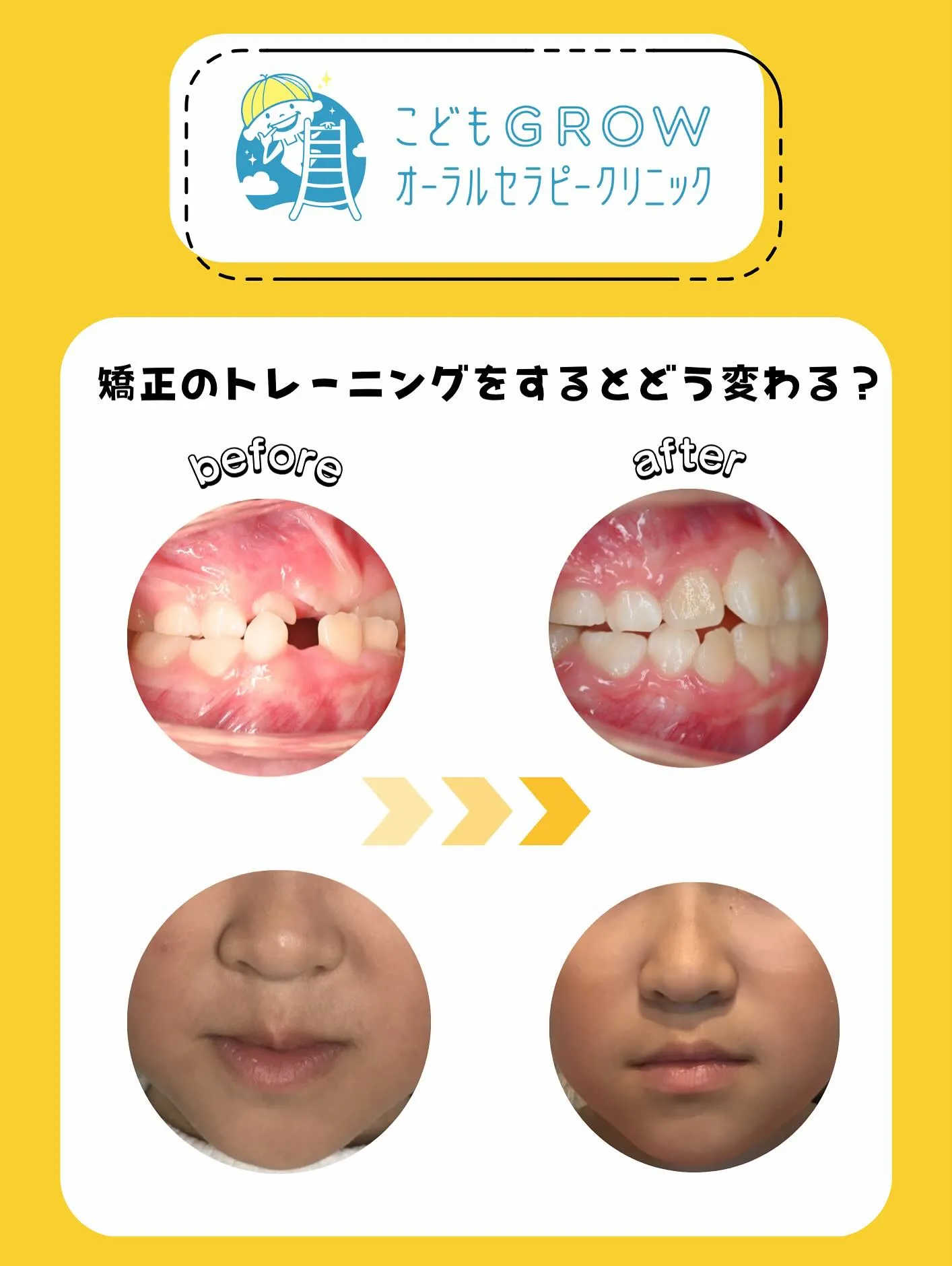 8歳女の子の経過途中の矯正症例です👧