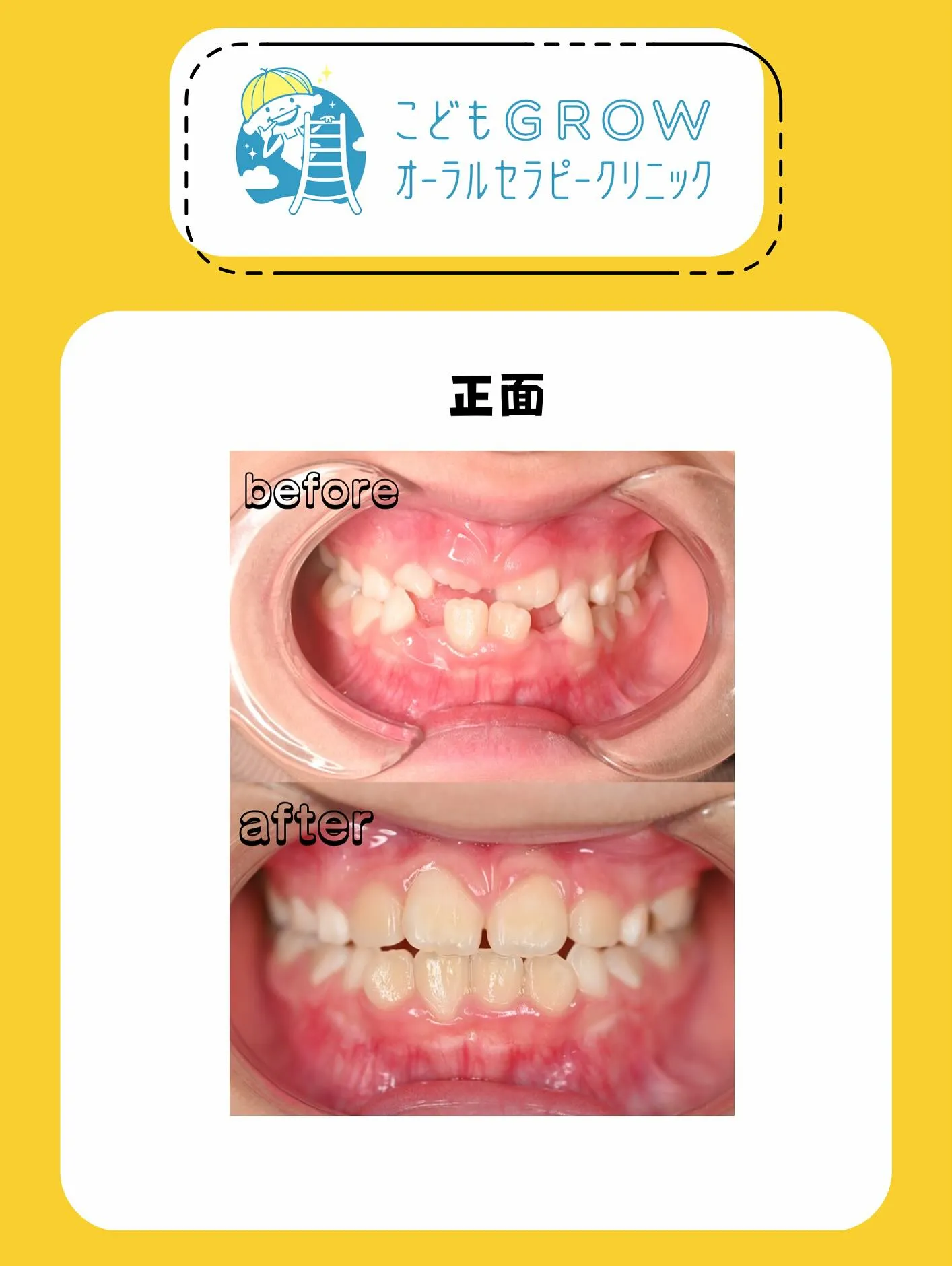 8歳女の子の経過途中の矯正症例です👧