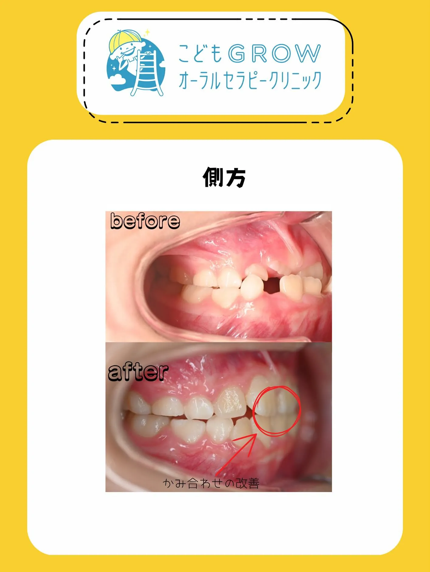 8歳女の子の経過途中の矯正症例です👧