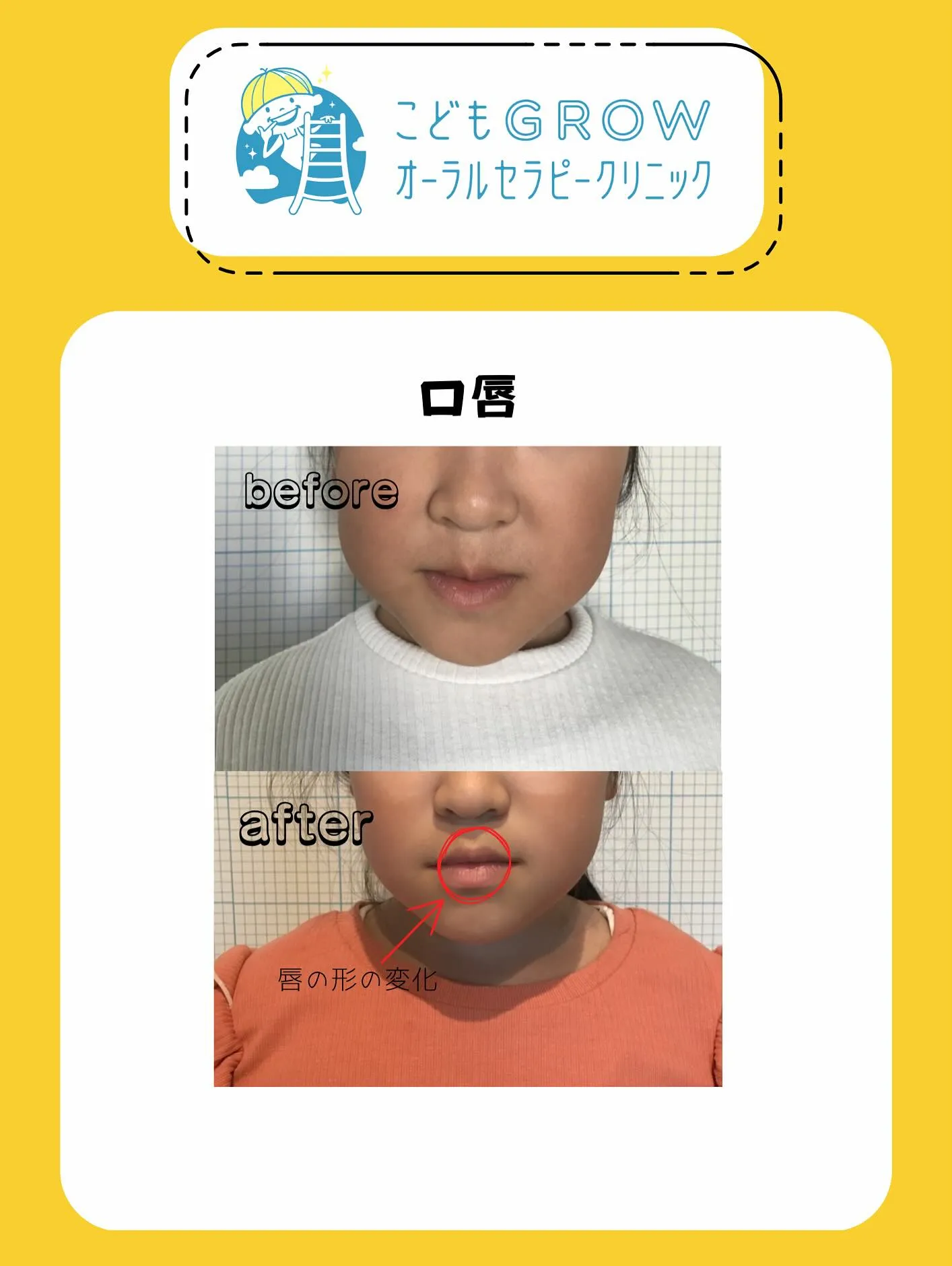 8歳女の子の経過途中の矯正症例です👧