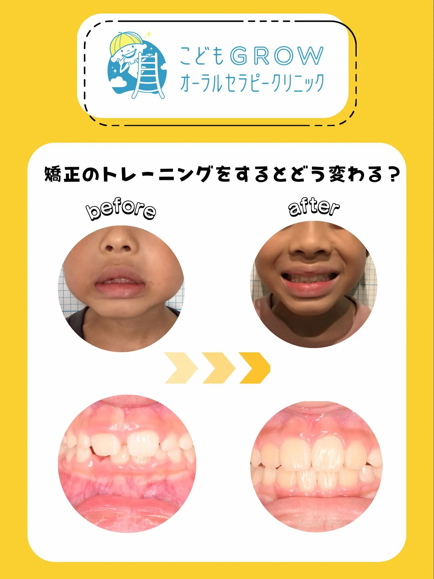 8歳男の子矯正症例です👦