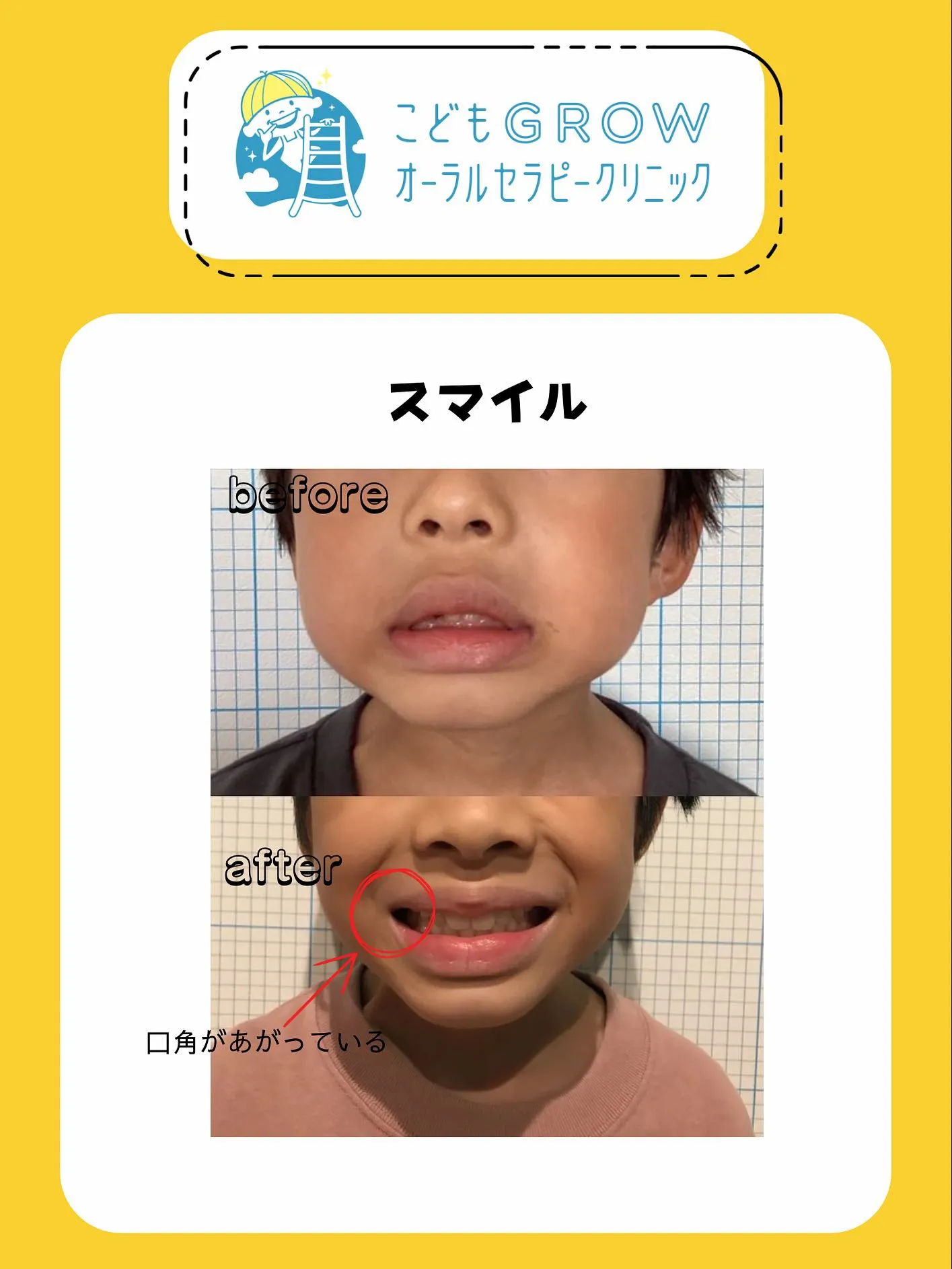 8歳男の子矯正症例です👦